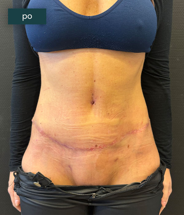 Abdominoplastyka_1_po_dr_lis