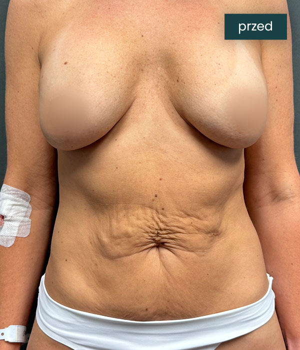 Abdominoplastyka_1_przed_dr_lis