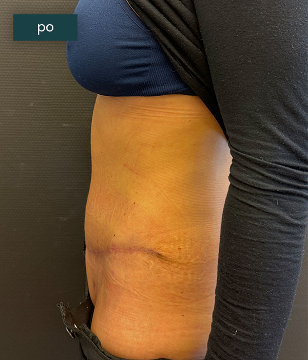 Abdominoplastyka_2_po_dr_lis