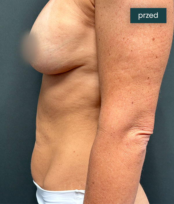 Abdominoplastyka_2_przed_dr_lis