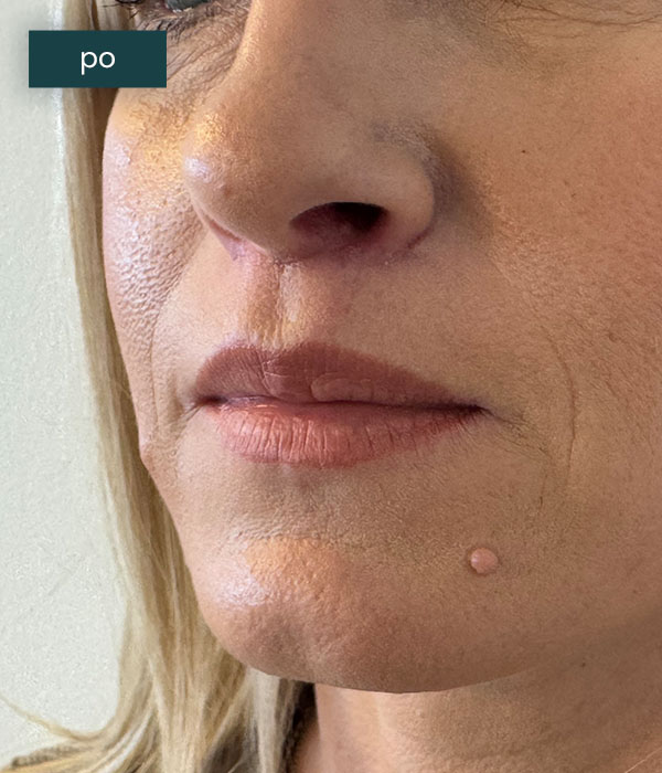 Liplift_1_po_dr_lis