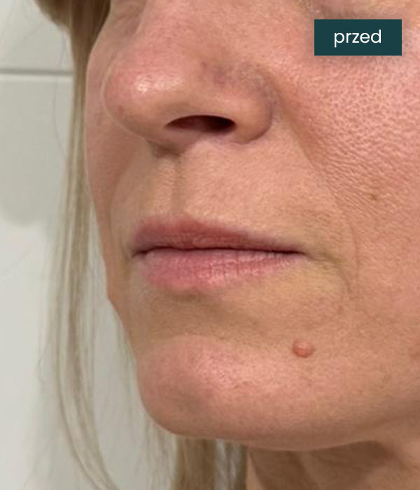 Liplift_1_przed_dr_lis
