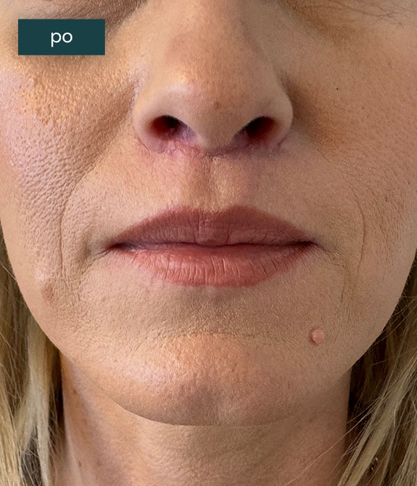 Liplift_2_po_dr_lis