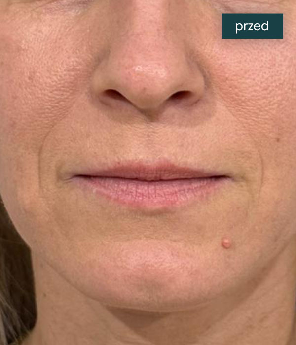 Liplift_2_przed_dr_lis