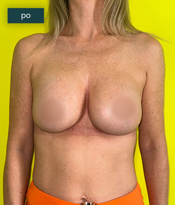 Powiekszanie_piersi_1_po_dr_lis