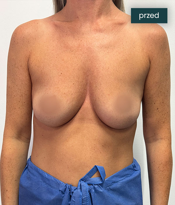 Powiekszanie_piersi_1_przed_dr_lis