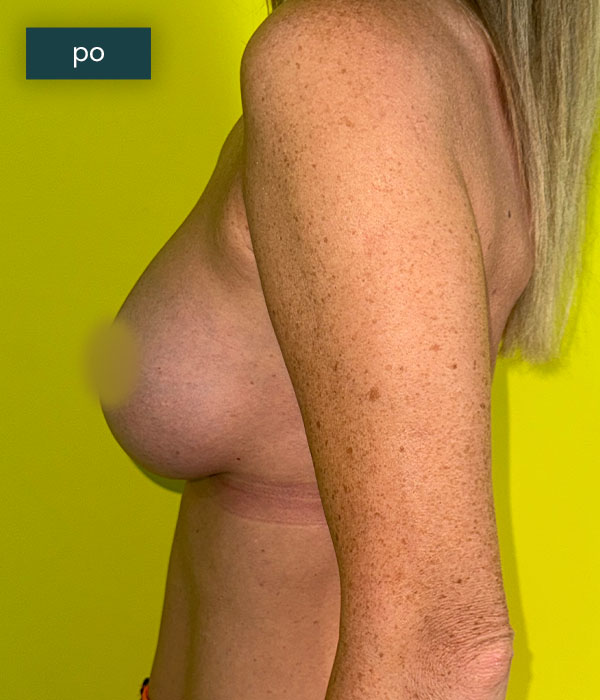 Powiekszanie_piersi_2_po_dr_lis