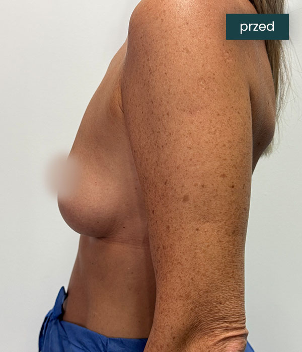 Powiekszanie_piersi_2_przed_dr_lis