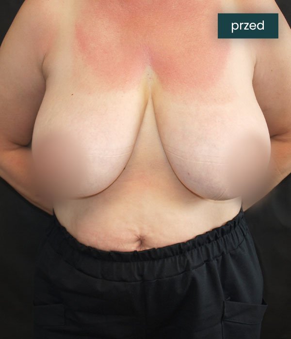 Redukcja_piersi_1_przed_dr_lis