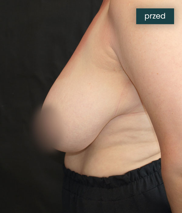 Redukcja_piersi_2_przed_dr_lis